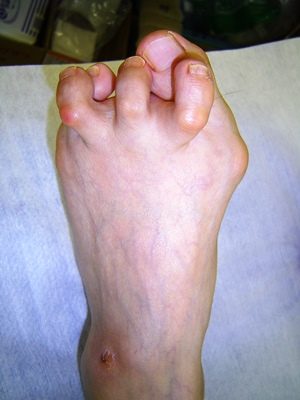 関節リウマチ足趾変形１