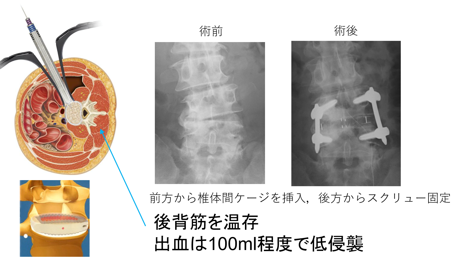 本格派ま！ TheSpine脊椎・脊髄外科 原著5版 | www.barkat.tv